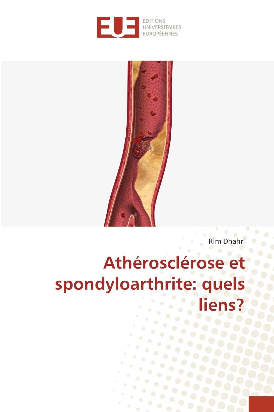Athérosclérose et spondyloarthrite: quels liens? Medicine
