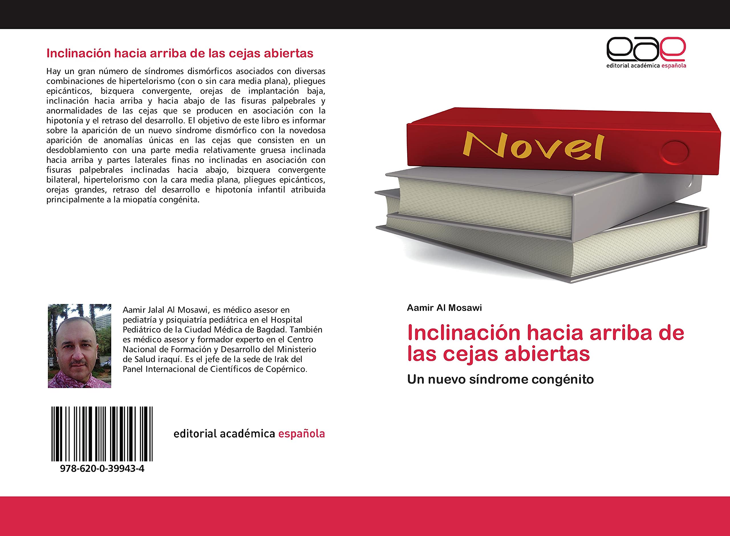 Inclinación hacia arriba de las cejas abiertas: Un nuevo síndrome congénito book