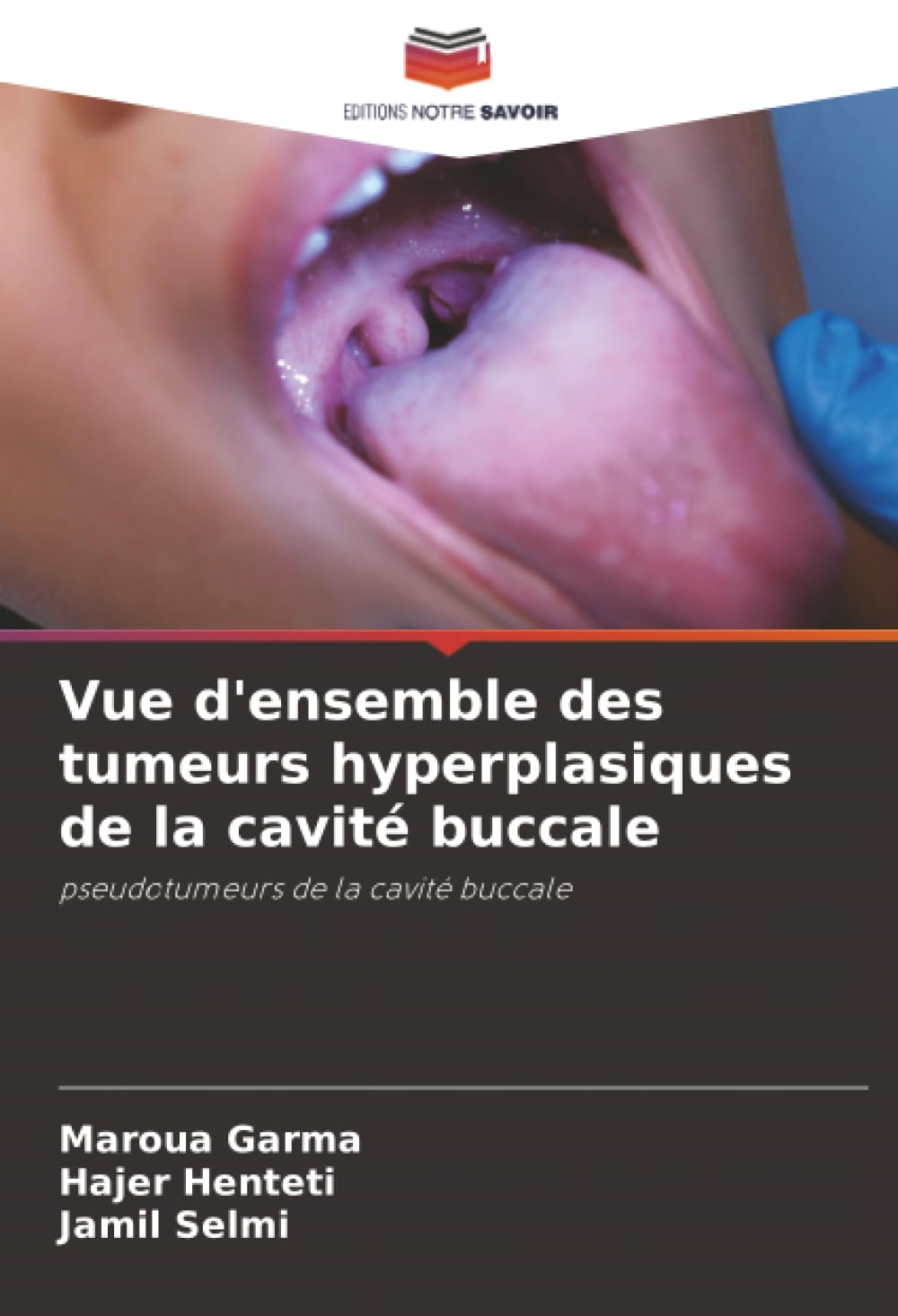 Vue d'ensemble des tumeurs hyperplasiques de la cavité buccale: pseudotumeurs de la cavité buccale Medicine
