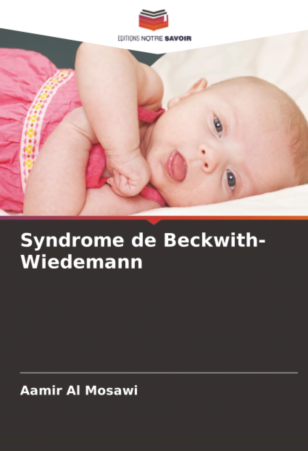 Syndrome de Beckwith-Wiedemann Medicine