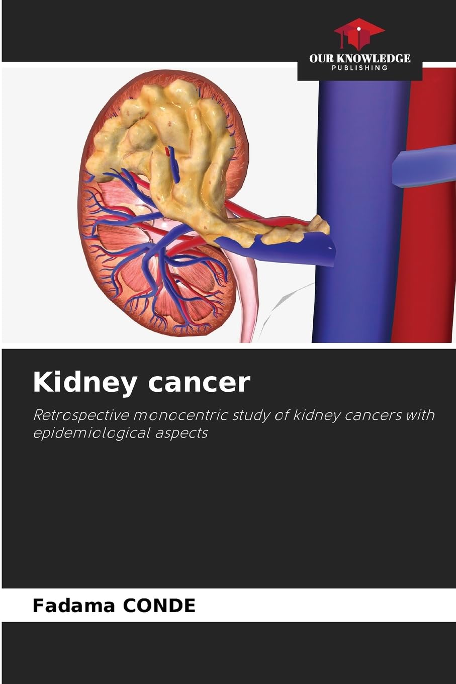 Product Image: Kidney cancer