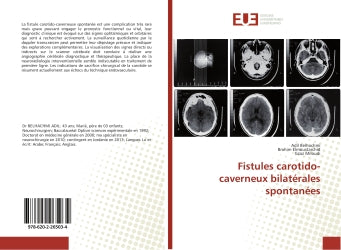 Fistules carotido-caverneux bilatérales spontanées book