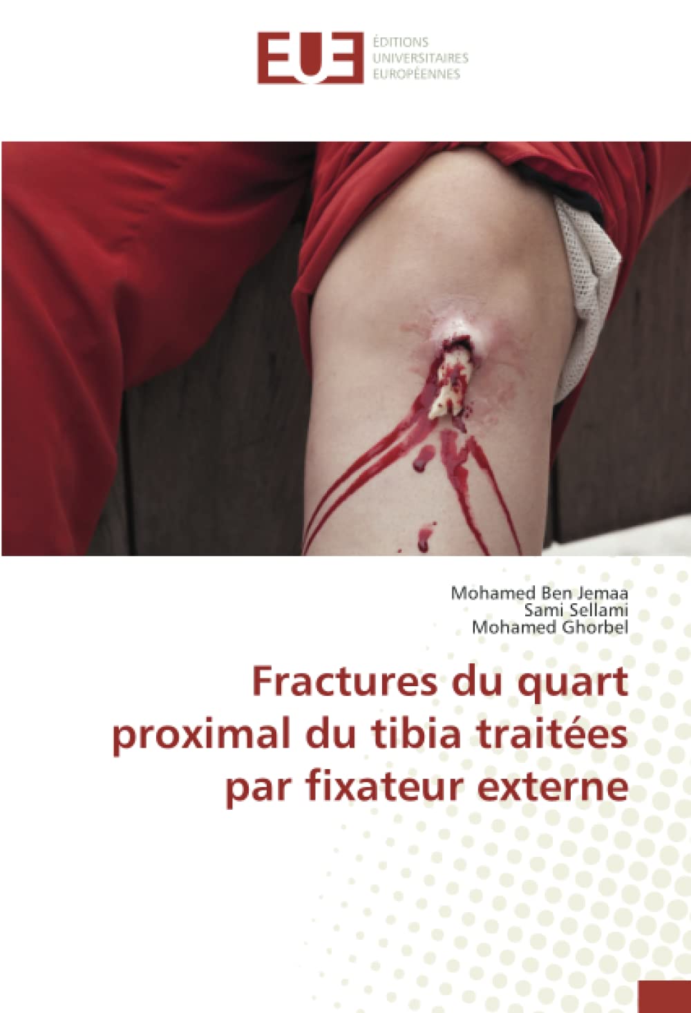 Fractures du quart proximal du tibia traitées par fixateur externe book