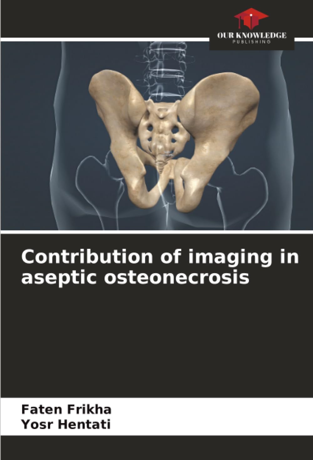 Contribution of imaging in aseptic osteonecrosis Medicine