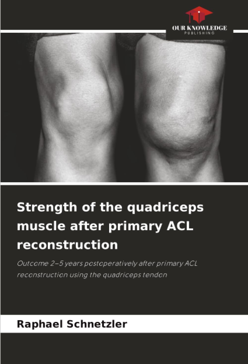 Strength of the quadriceps muscle after primary ACL reconstruction Medicine