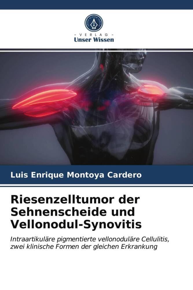 Riesenzelltumor der Sehnenscheide und Vellonodul-Synovitis: Intraartikuläre pigmentierte vellonoduläre Cellulitis, zwei klinische Formen der gleichen Erkrankung Medicine