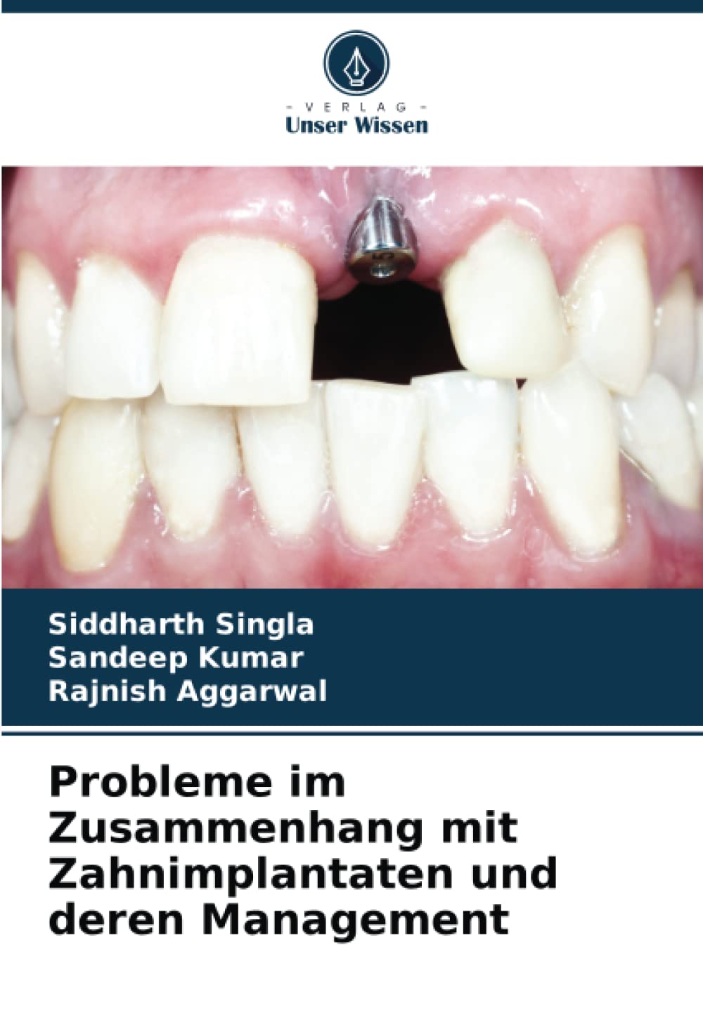 Probleme im Zusammenhang mit Zahnimplantaten und deren Management Medicine