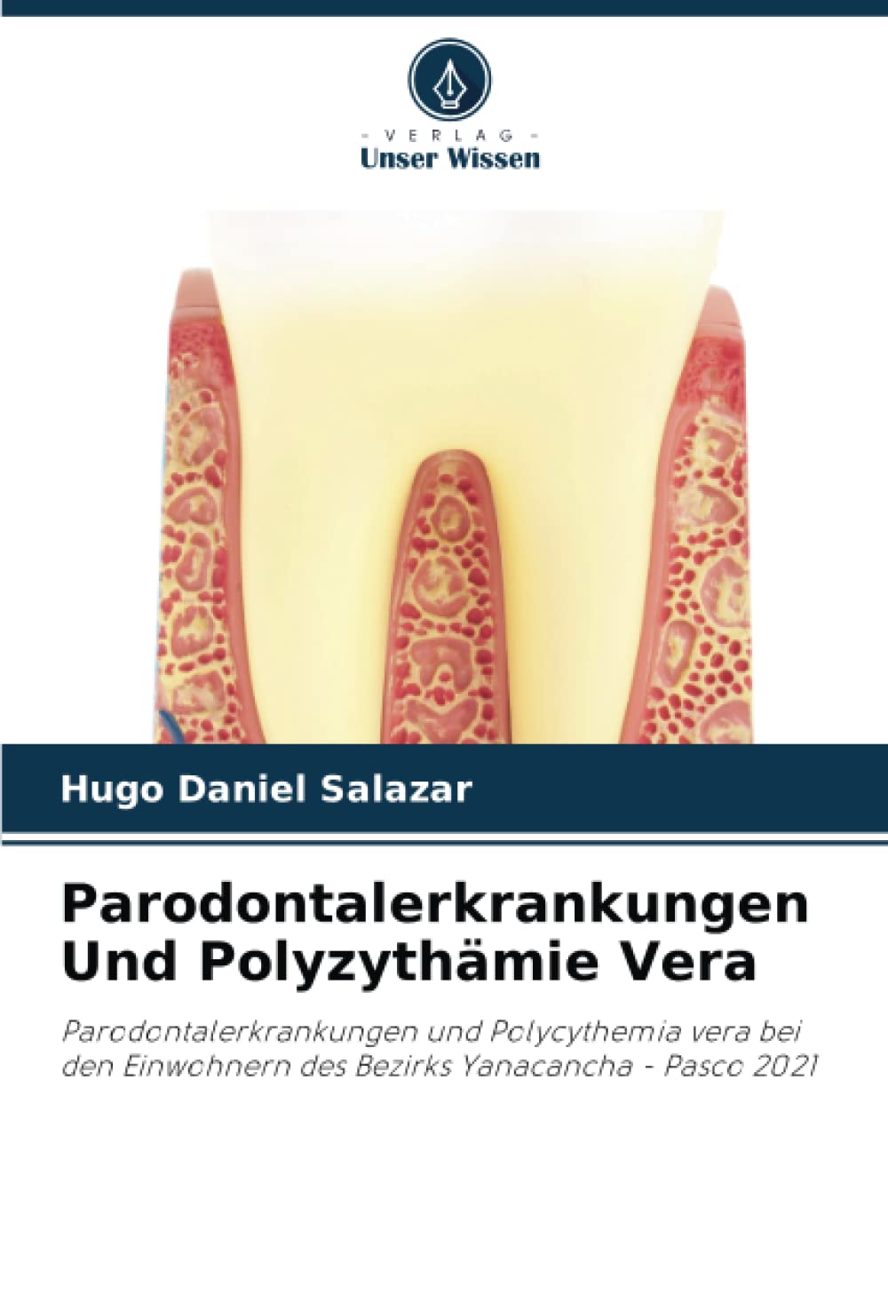 Parodontalerkrankungen Und Polyzythämie Vera: Parodontalerkrankungen und Polycythemia vera bei den Einwohnern des Bezirks Yanacancha - Pasco 2021 Law