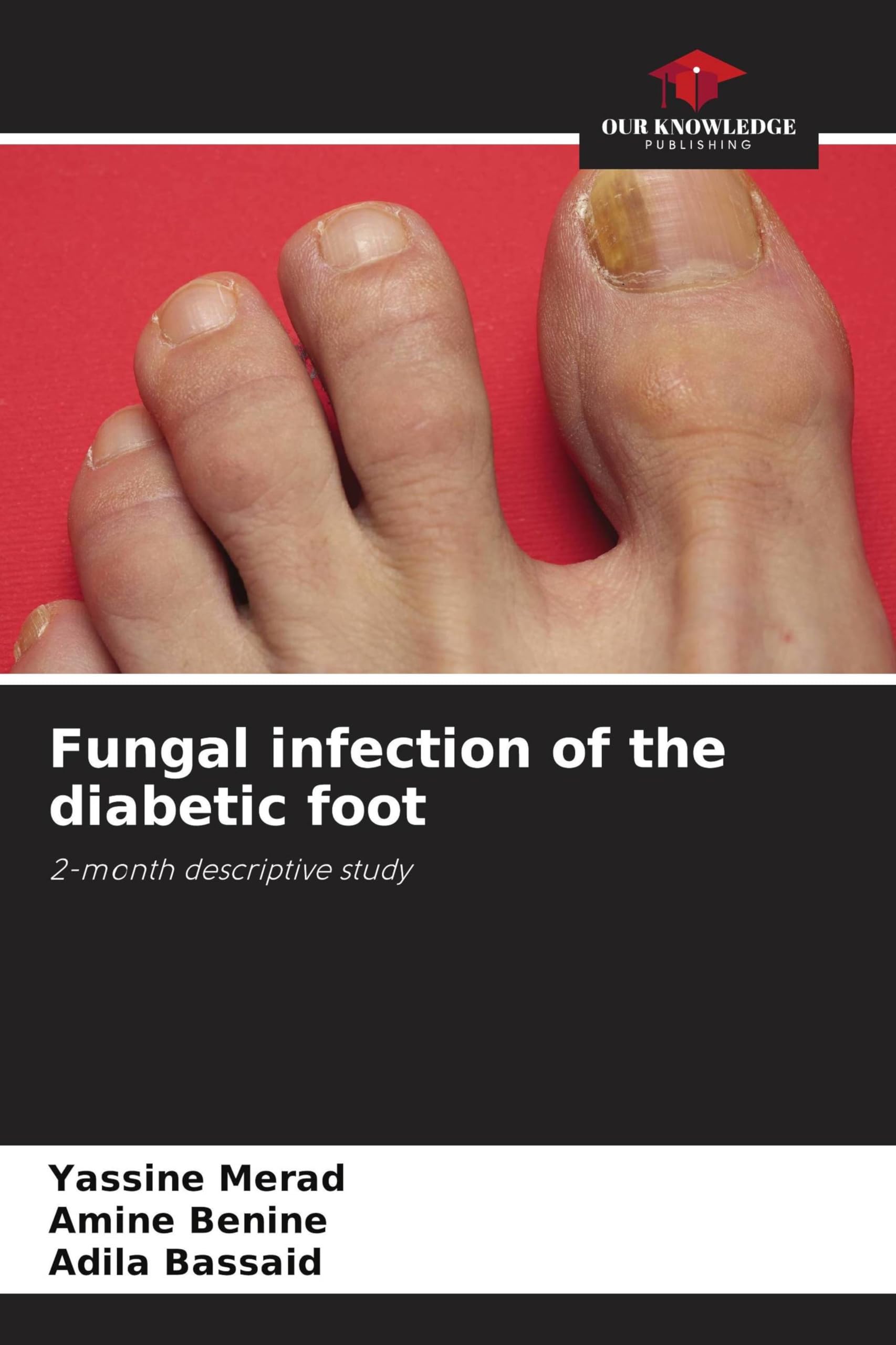 Fungal infection of the diabetic foot: 2-month descriptive study.DE Medicine