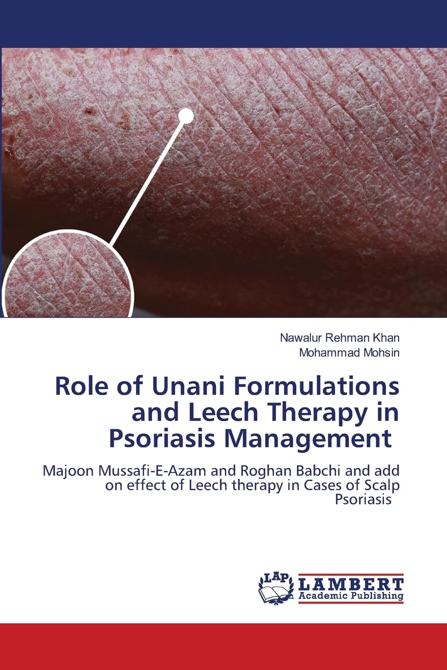 Role of Unani Formulations and Leech Therapy in Psoriasis Management Medicine