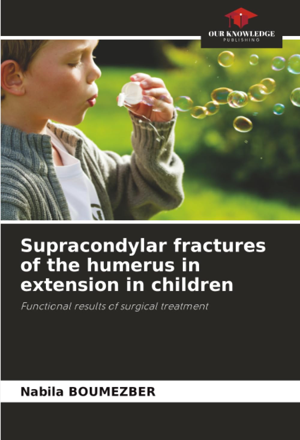 Supracondylar fractures of the humerus in extension in children Medicine