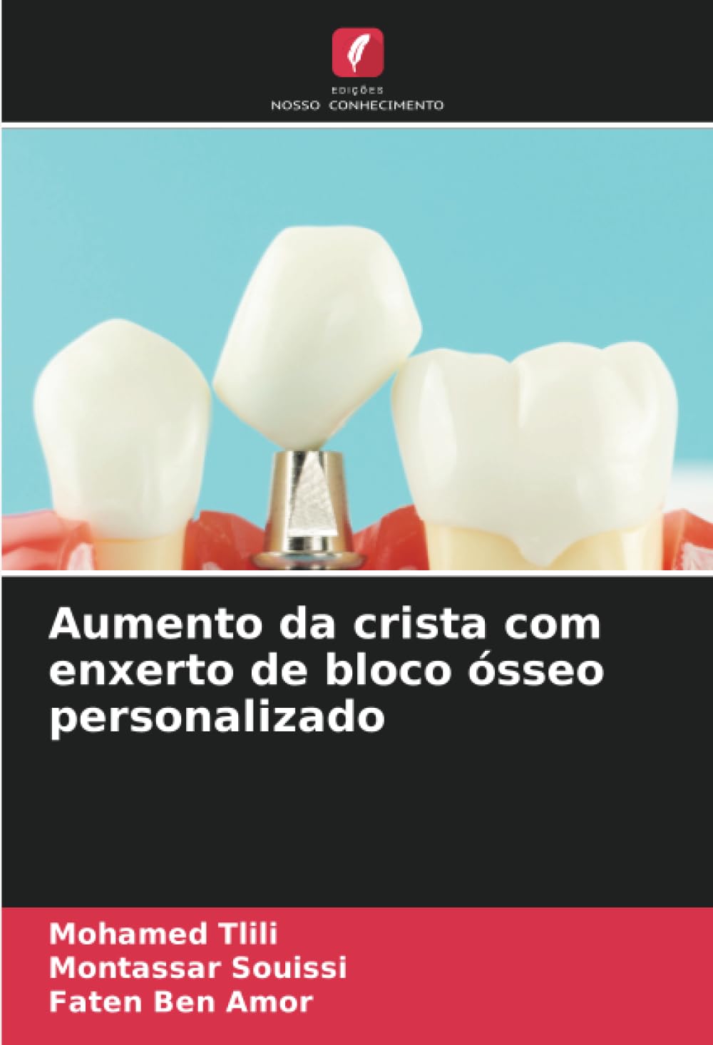 Aumento da crista com enxerto de bloco ósseo personalizado Medicine