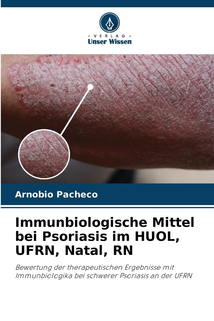 Immunbiologische Mittel bei Psoriasis im HUOL, UFRN, Natal, RN Medicine