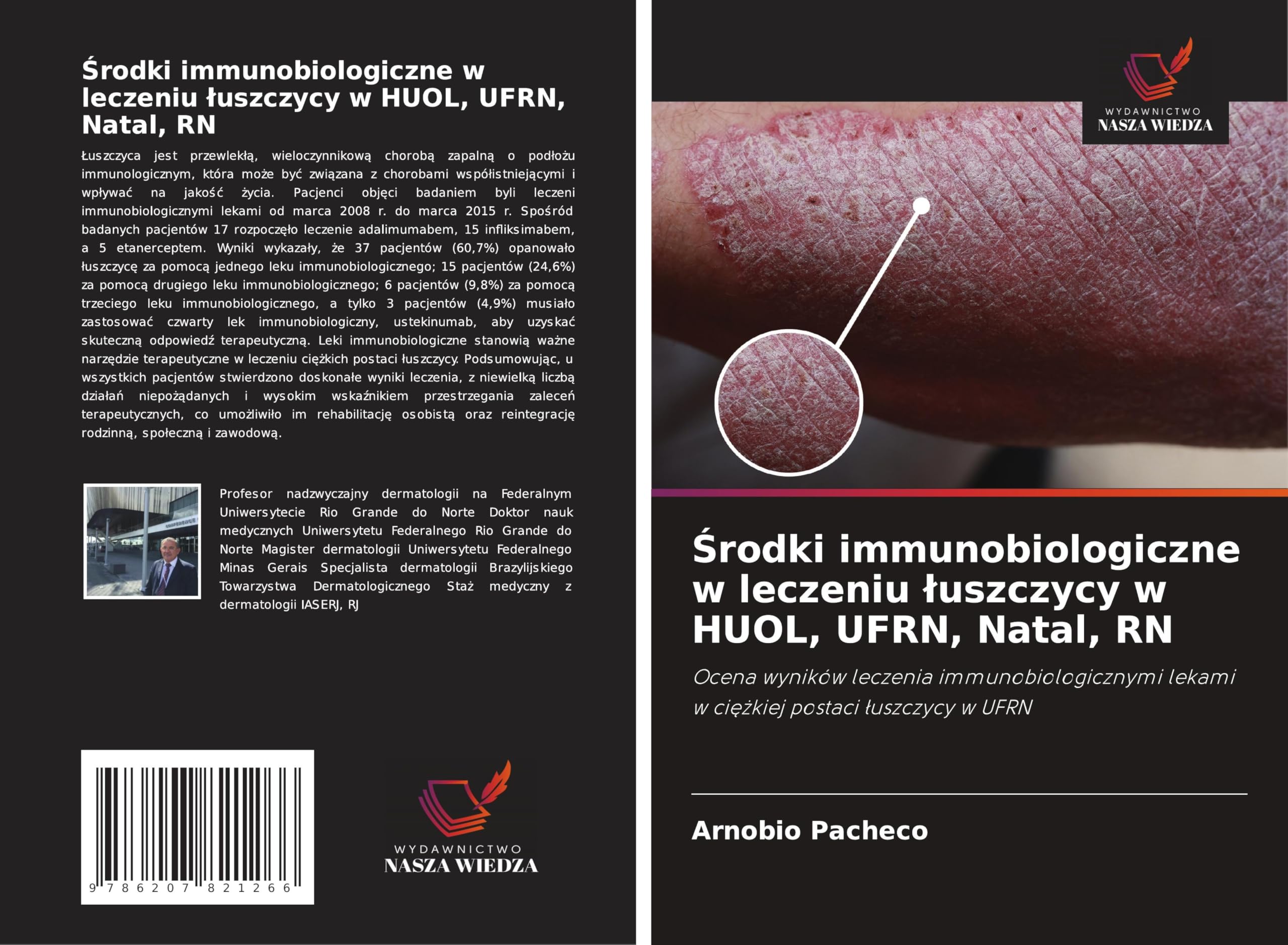 ¿rodki immunobiologiczne w leczeniu ¿uszczycy w HUOL, UFRN, Natal, RN Medicine
