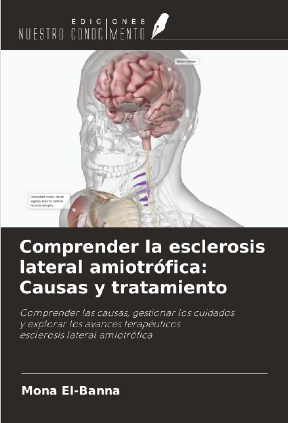 Comprender la esclerosis lateral amiotrófica: Causas y tratamiento Natural Sciences