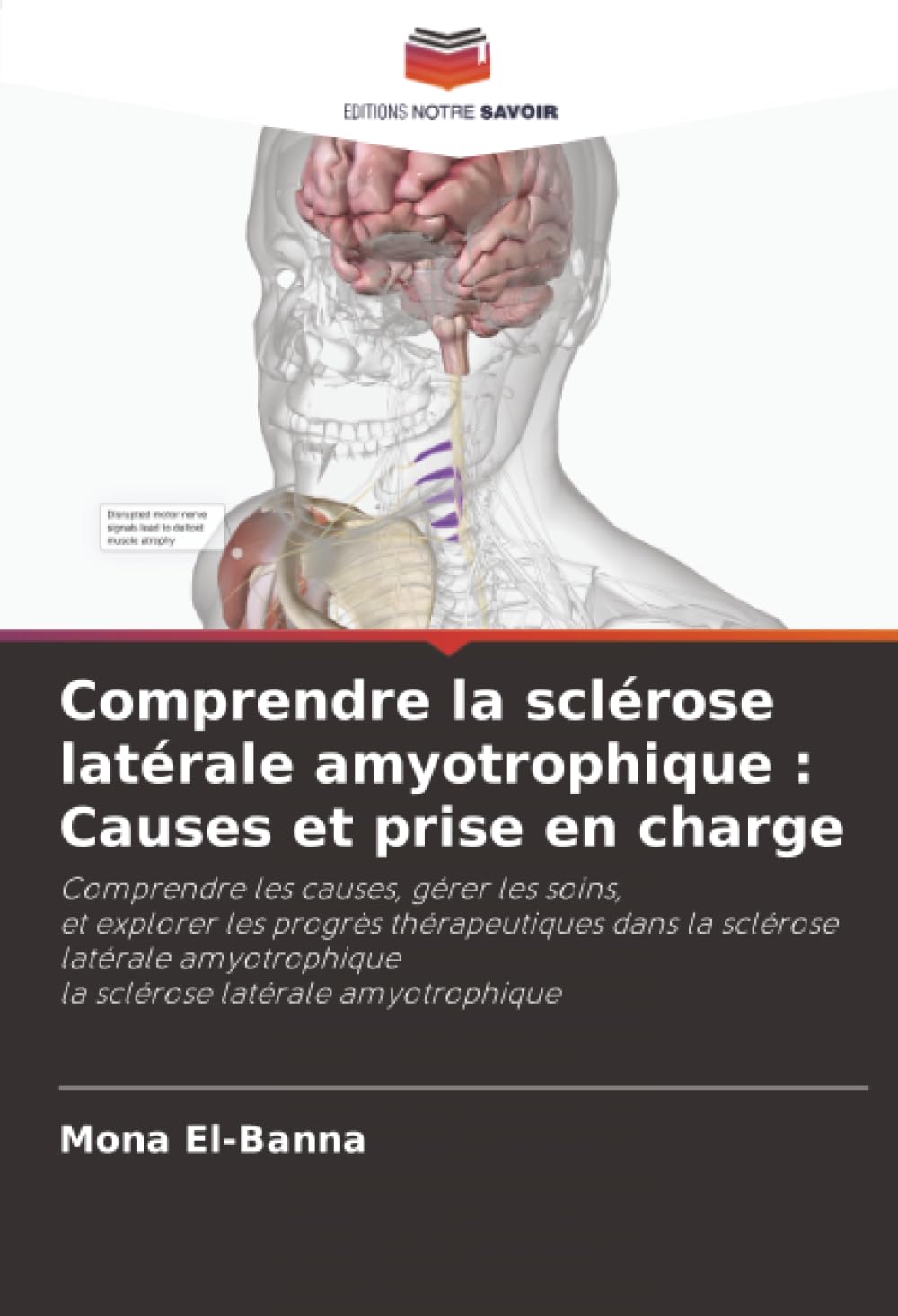 Comprendre la sclérose latérale amyotrophique : Causes et prise en charge Natural Sciences