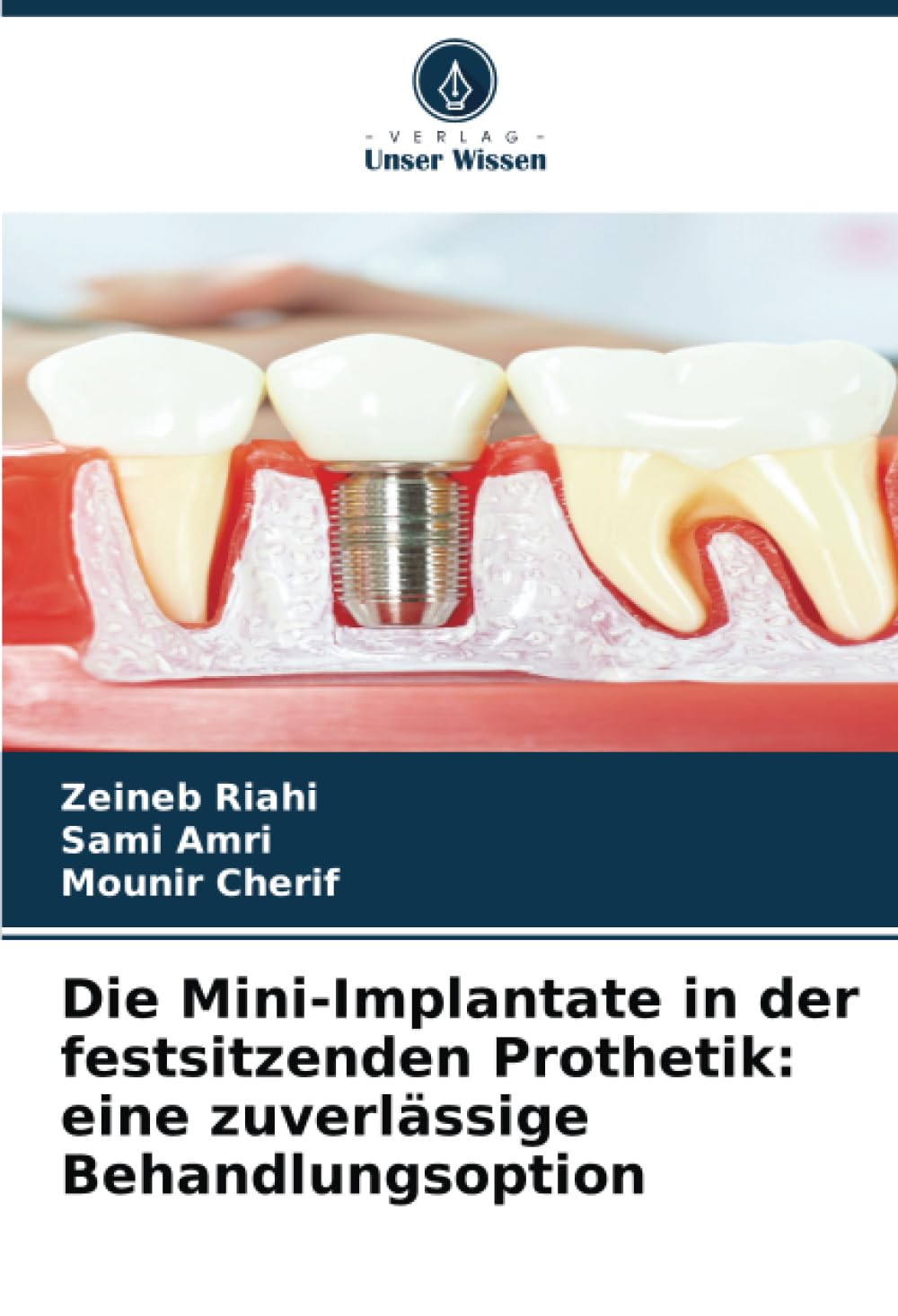 Die Mini-Implantate in der festsitzenden Prothetik: eine zuverlässige Behandlungsoption Law