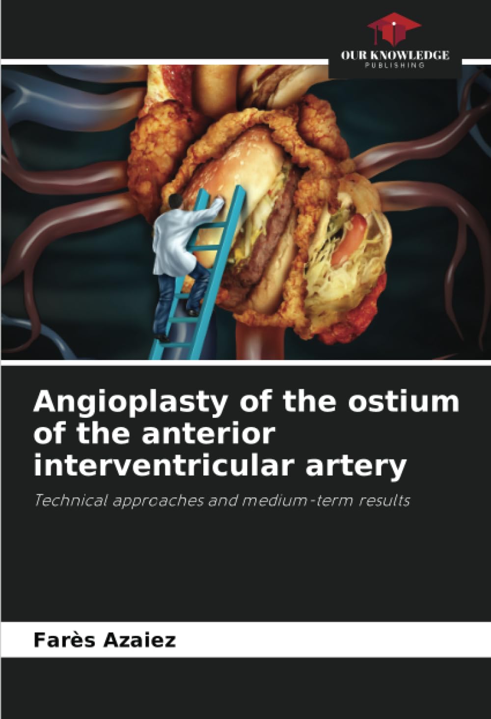 Angioplasty of the ostium of the anterior interventricular artery Medicine