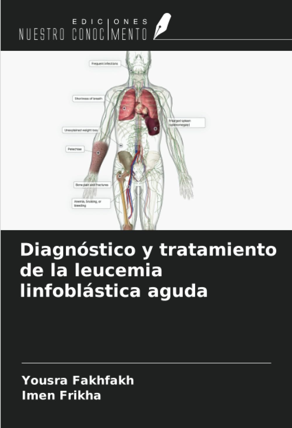 Diagnóstico y tratamiento de la leucemia linfoblástica aguda Medicine