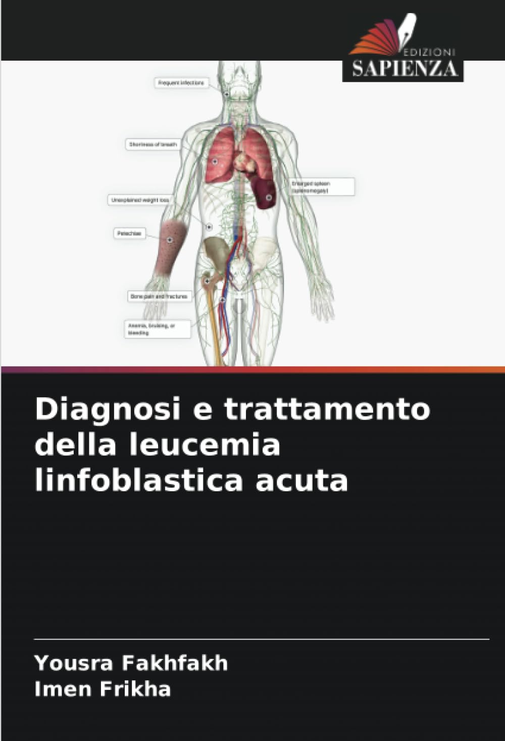 Diagnosi e trattamento della leucemia linfoblastica acuta Medicine
