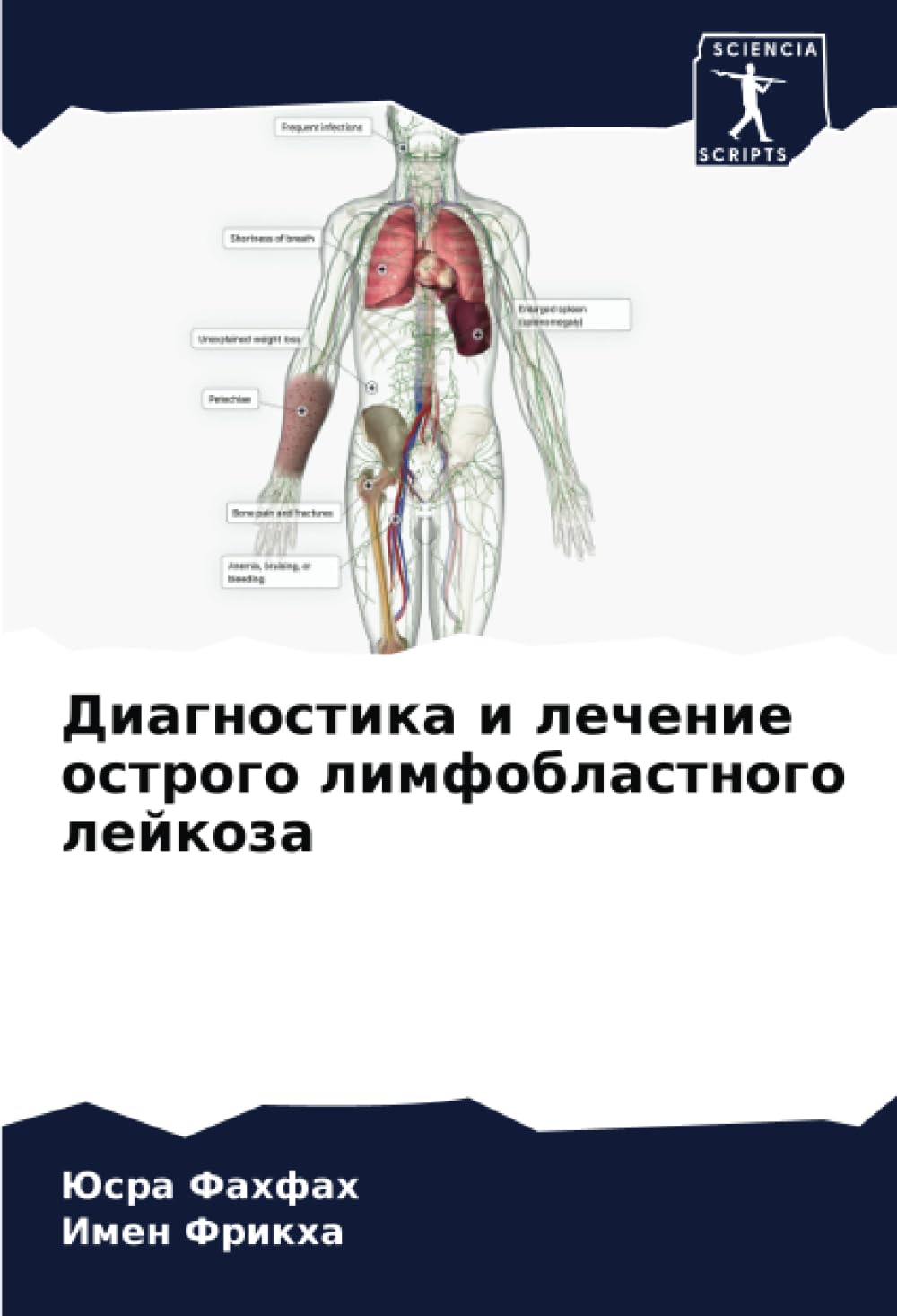 Diagnostika i lechenie ostrogo limfoblastnogo lejkoza Medicine