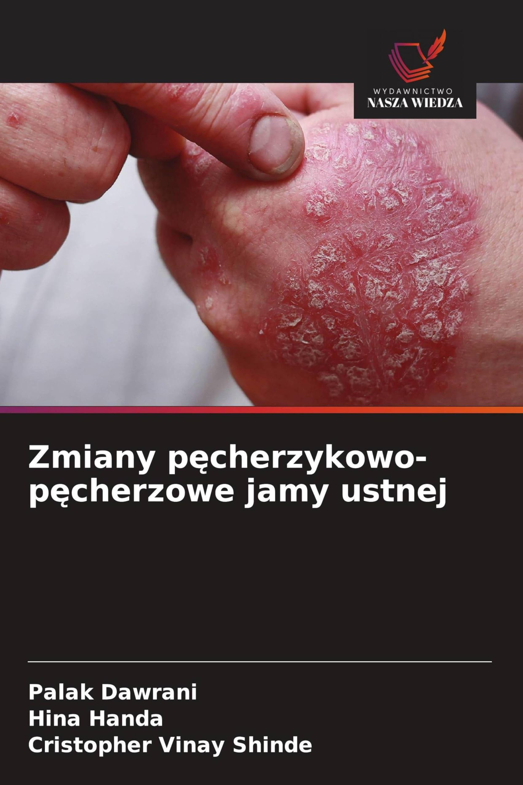 Zmiany p¿cherzykowo-p¿cherzowe jamy ustnej Medicine