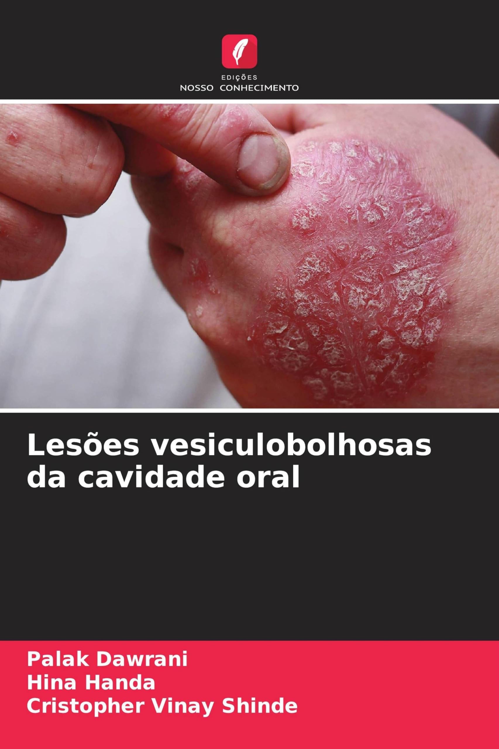 Lesões vesiculobolhosas da cavidade oral Medicine