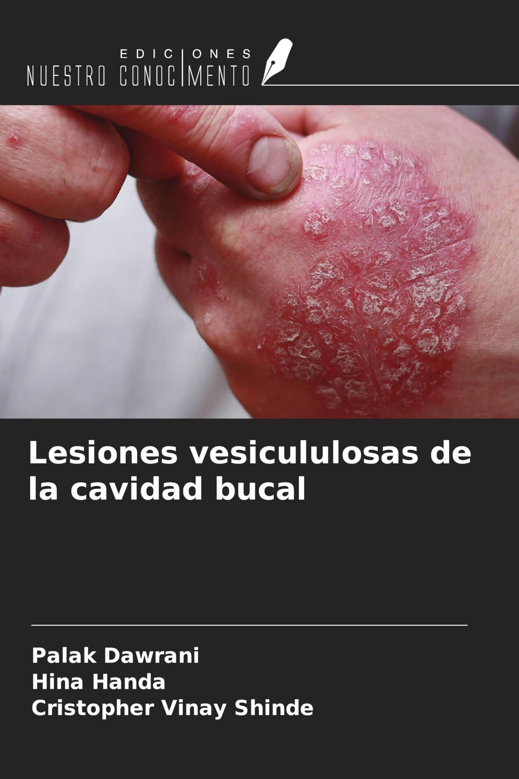 Lesiones vesicululosas de la cavidad bucal Medicine