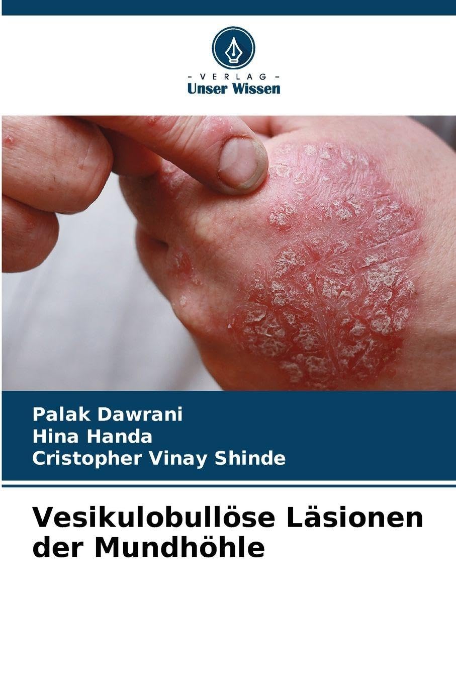 Vesikulobullöse Läsionen der Mundhöhle Medicine