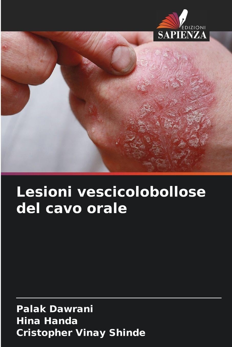 Lesioni vescicolobollose del cavo orale Medicine