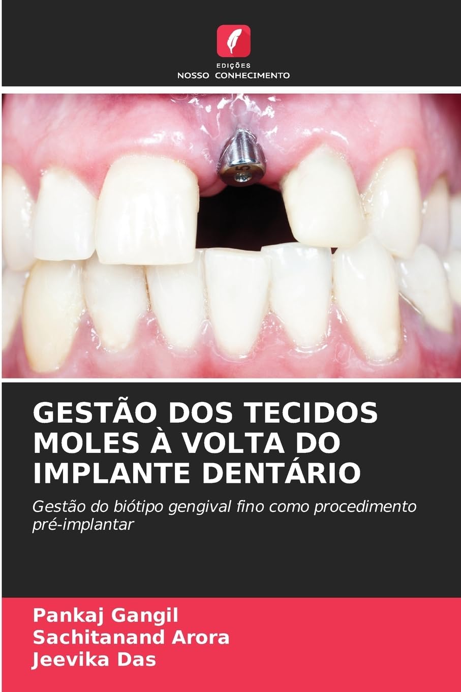 GESTÃO DOS TECIDOS MOLES À VOLTA DO IMPLANTE DENTÁRIO Medicine