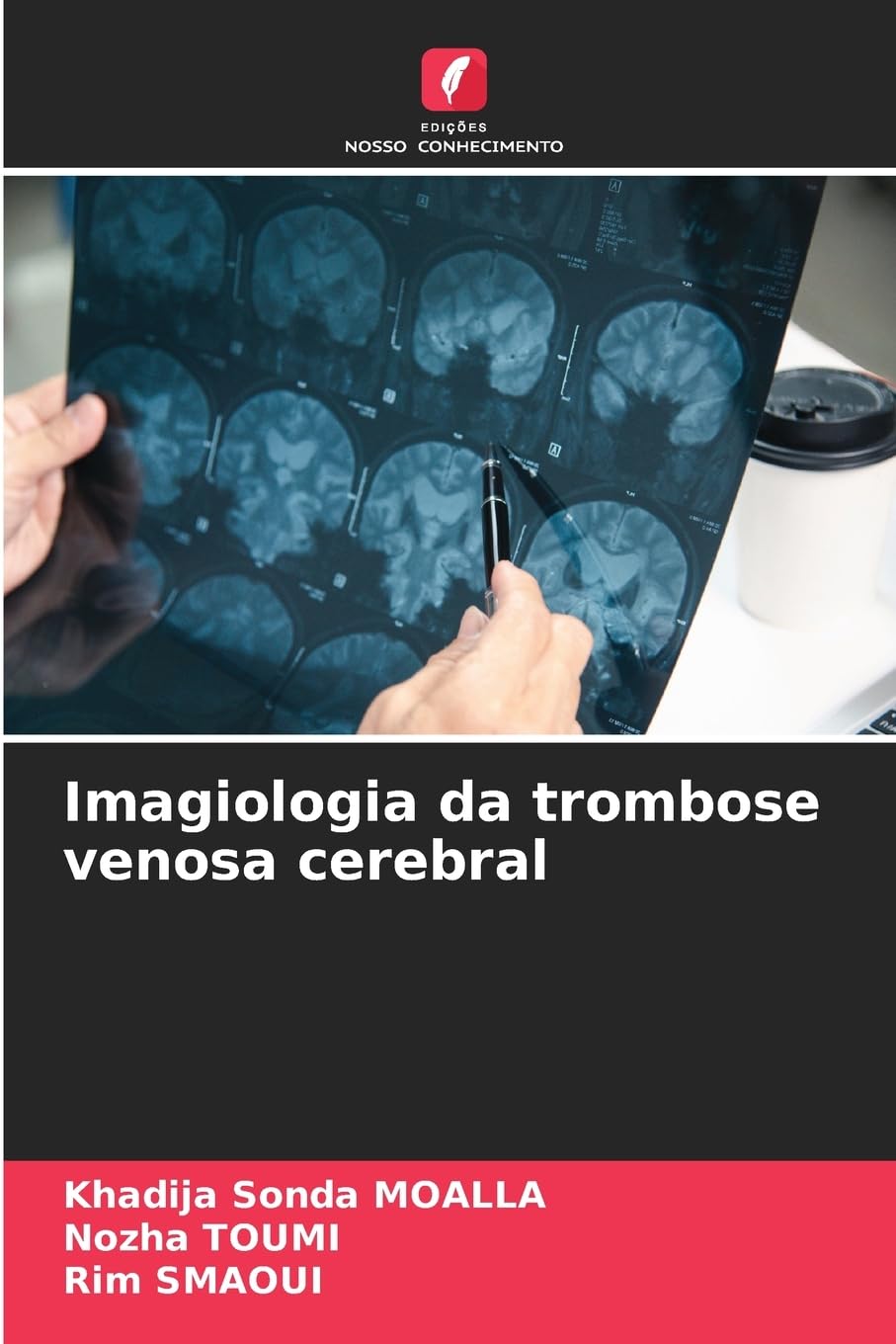 Imagiologia da trombose venosa cerebral Medicine
