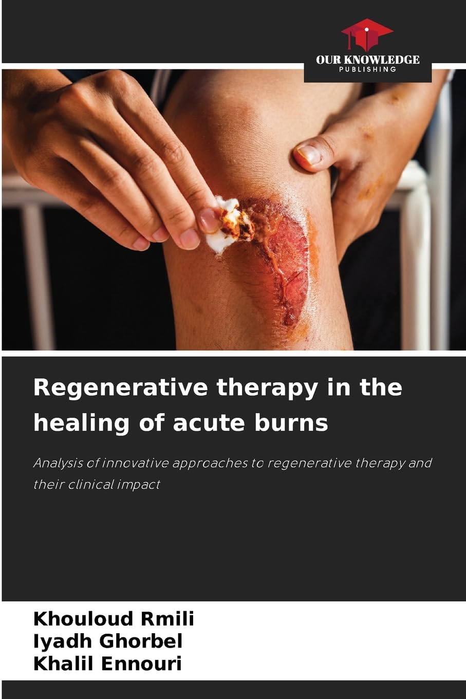 Regenerative therapy in the healing of acute burns Medicine