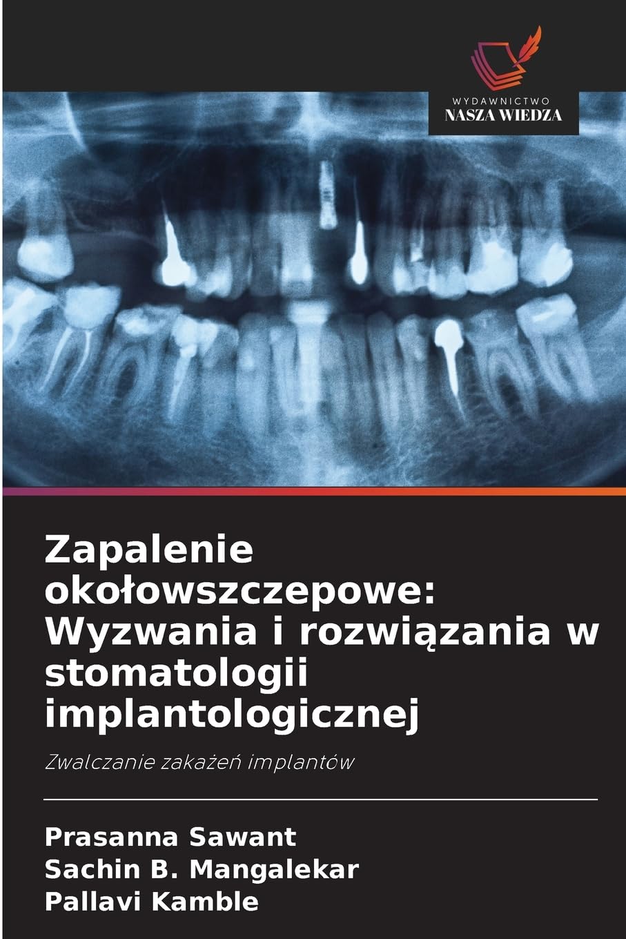 Zapalenie oko¿owszczepowe: Wyzwania i rozwi¿zania w stomatologii implantologicznej Medicine
