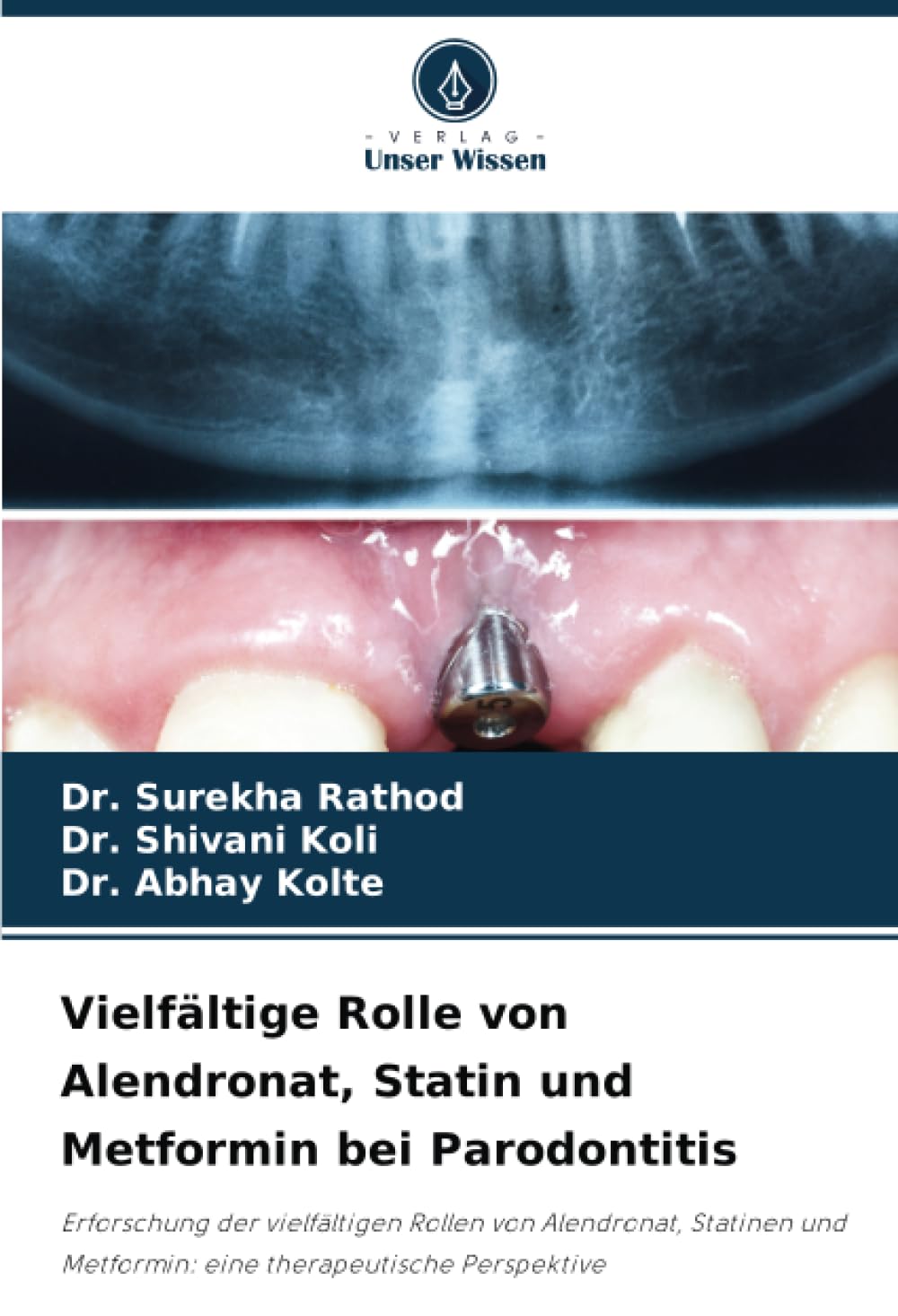 Vielfältige Rolle von Alendronat, Statin und Metformin bei Parodontitis Medicine