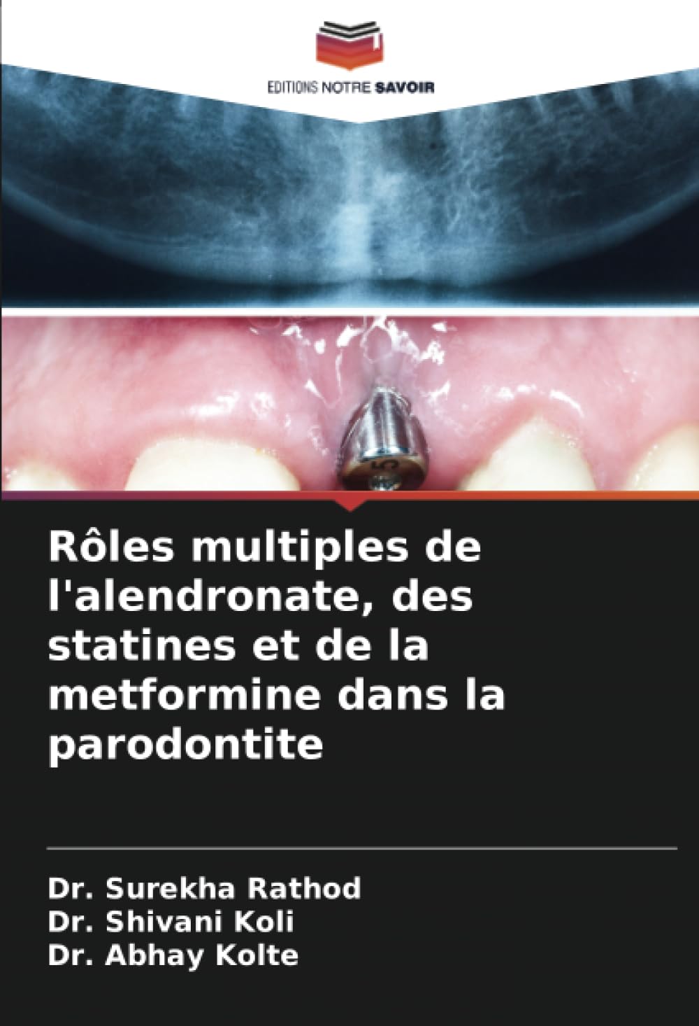Rôles multiples de l'alendronate, des statines et de la metformine dans la parodontite Medicine