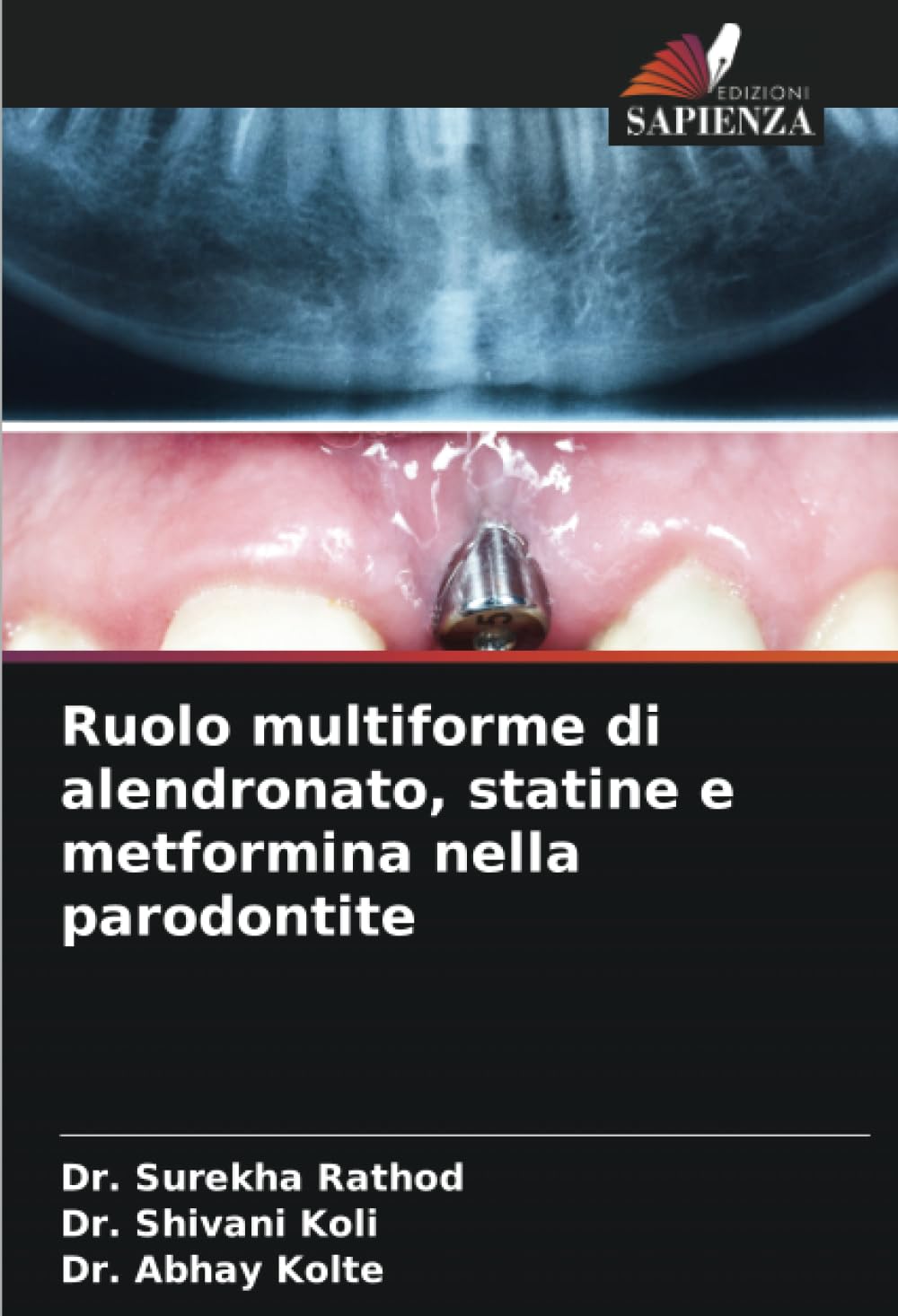 Ruolo multiforme di alendronato, statine e metformina nella parodontite Medicine