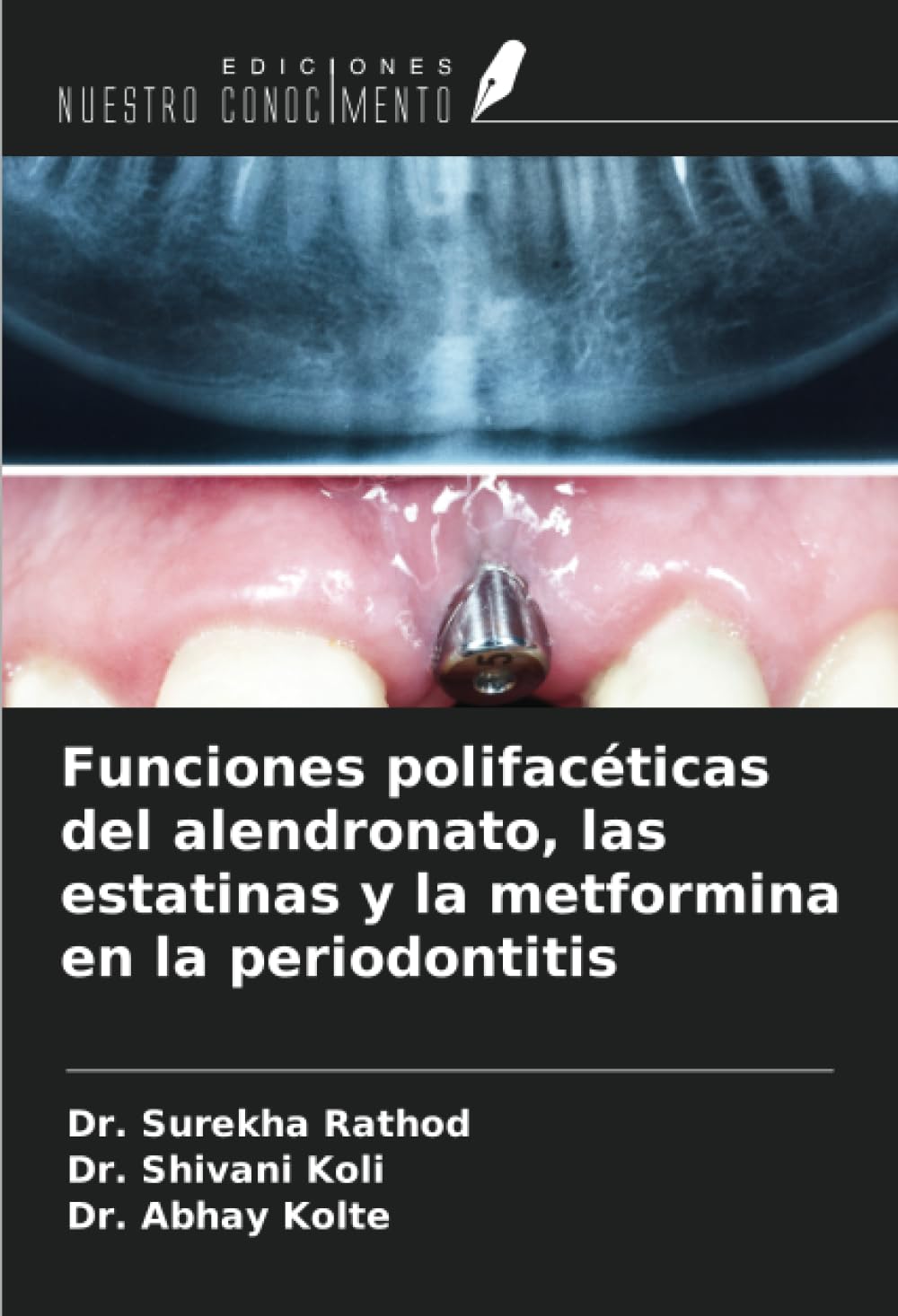 Funciones polifacéticas del alendronato, las estatinas y la metformina en la periodontitis Medicine