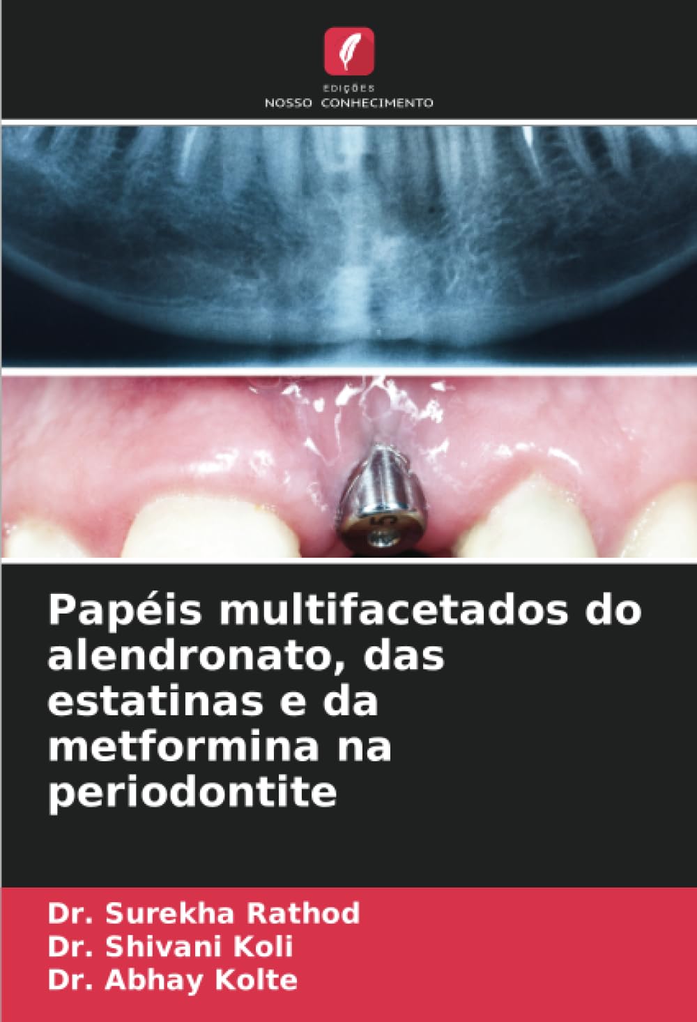 Papéis multifacetados do alendronato, das estatinas e da metformina na periodontite Medicine