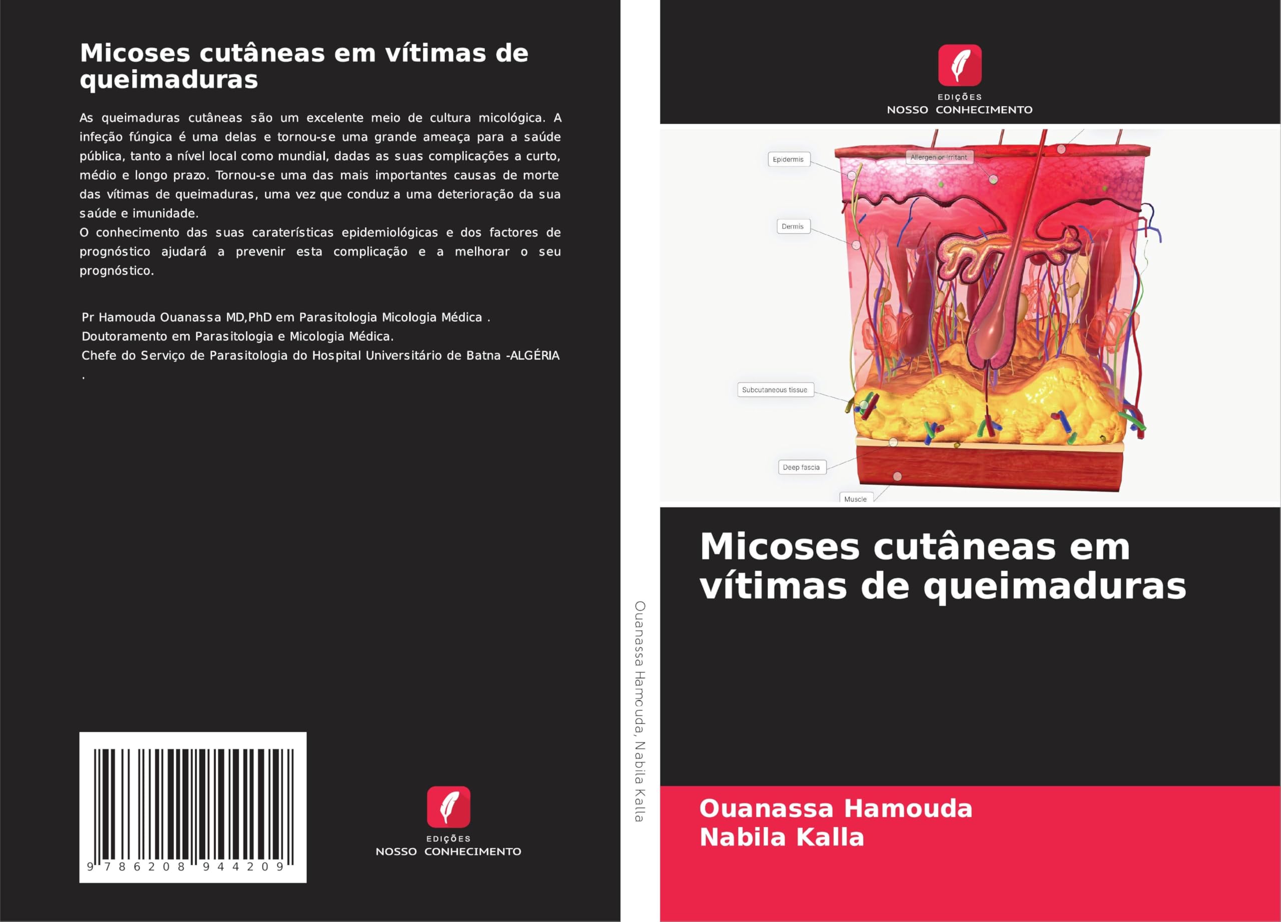 Micoses cutâneas em vítimas de queimaduras Medicine