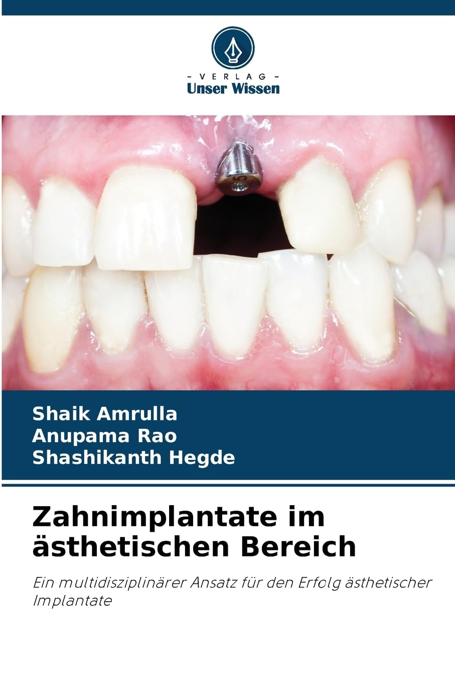 Zahnimplantate im ästhetischen Bereich Medicine