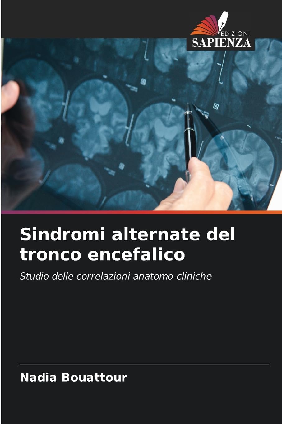 Sindromi alternate del tronco encefalico Medicine