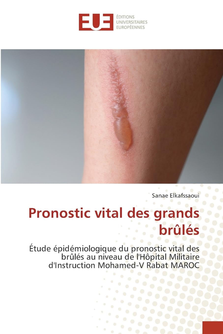 Pronostic vital des grands brûlés Medicine