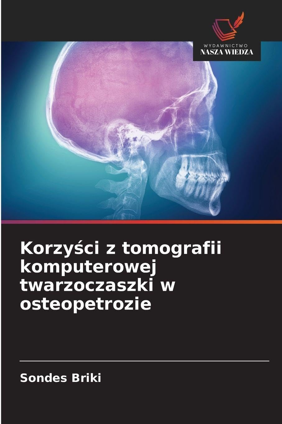 Korzy¿ci z tomografii komputerowej twarzoczaszki w osteopetrozie Medicine