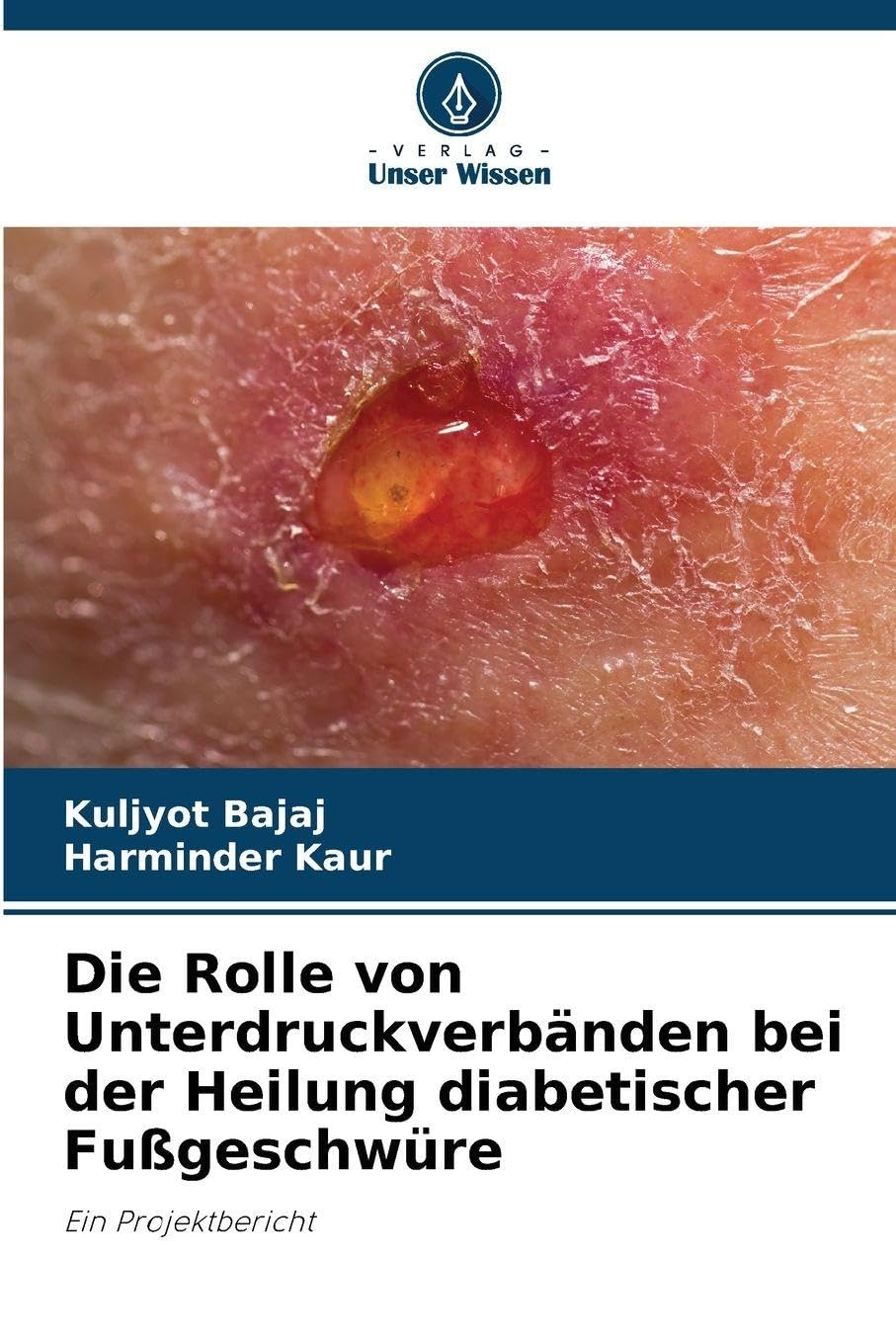 Die Rolle von Unterdruckverbänden bei der Heilung diabetischer Fußgeschwüre Medicine