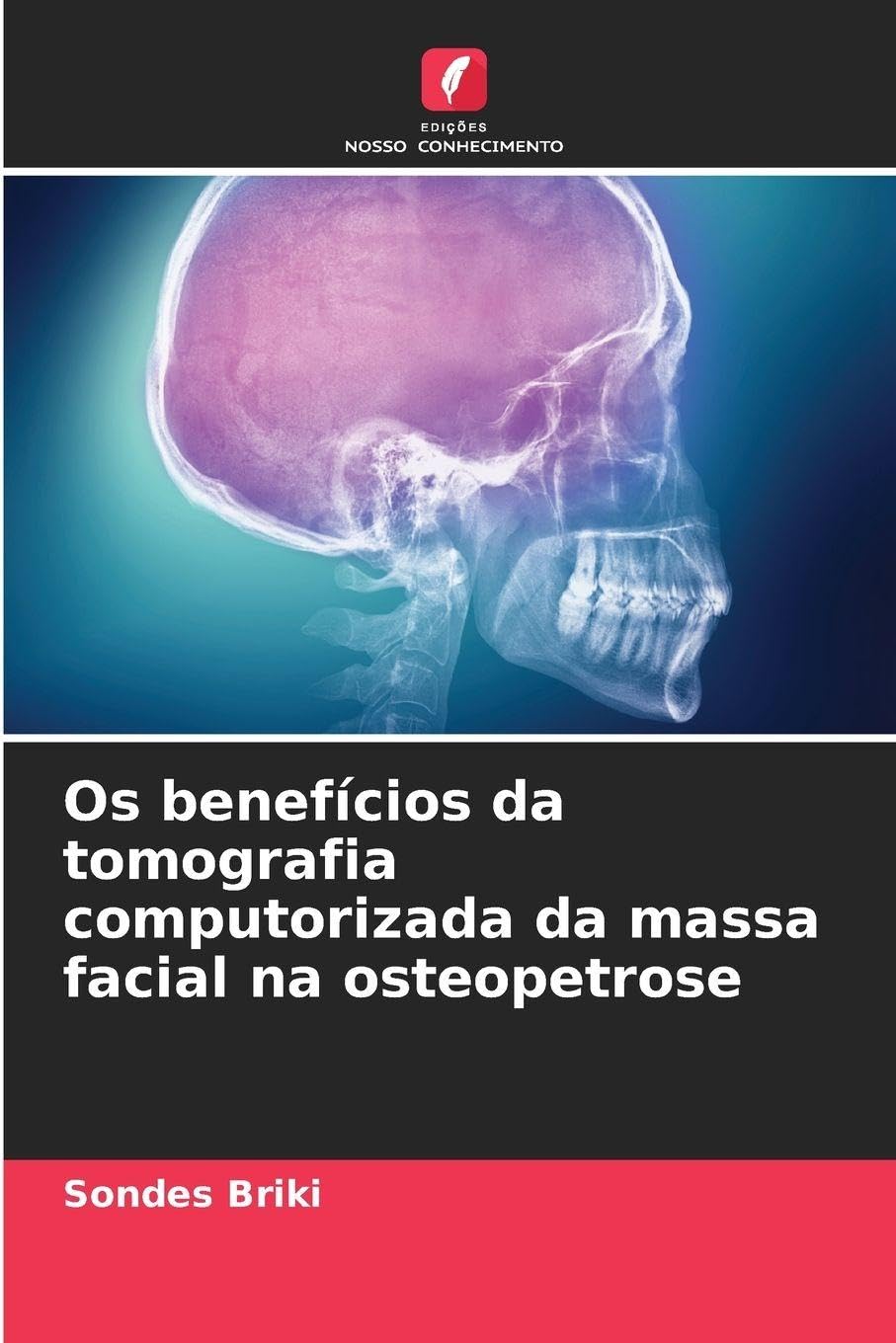 Os benefícios da tomografia computorizada da massa facial na osteopetrose Medicine