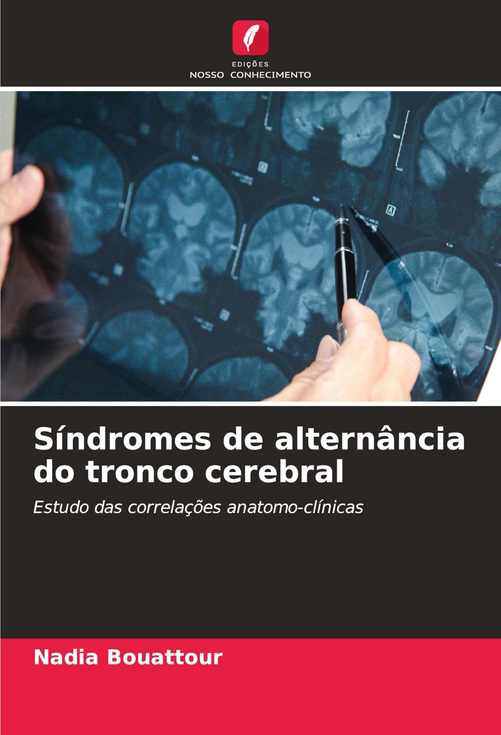 Síndromes de alternância do tronco cerebral Medicine