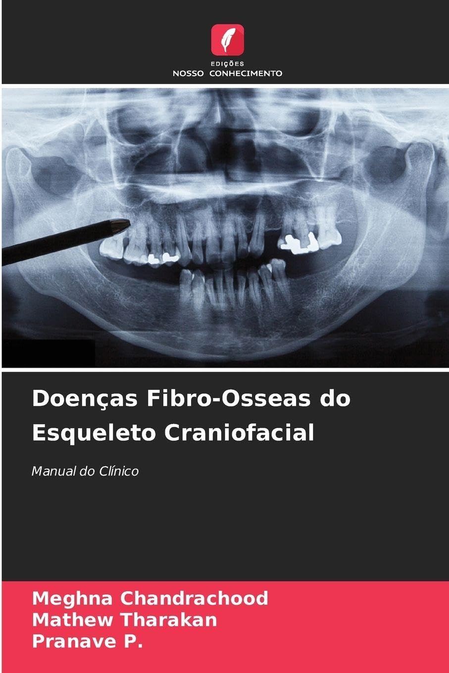 Doenças Fibro-Osseas do Esqueleto Craniofacial Medicine