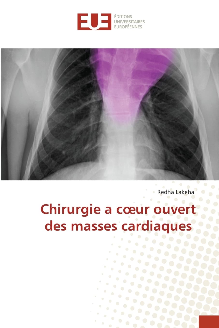 Chirurgie a c¿ur ouvert des masses cardiaques Medicine