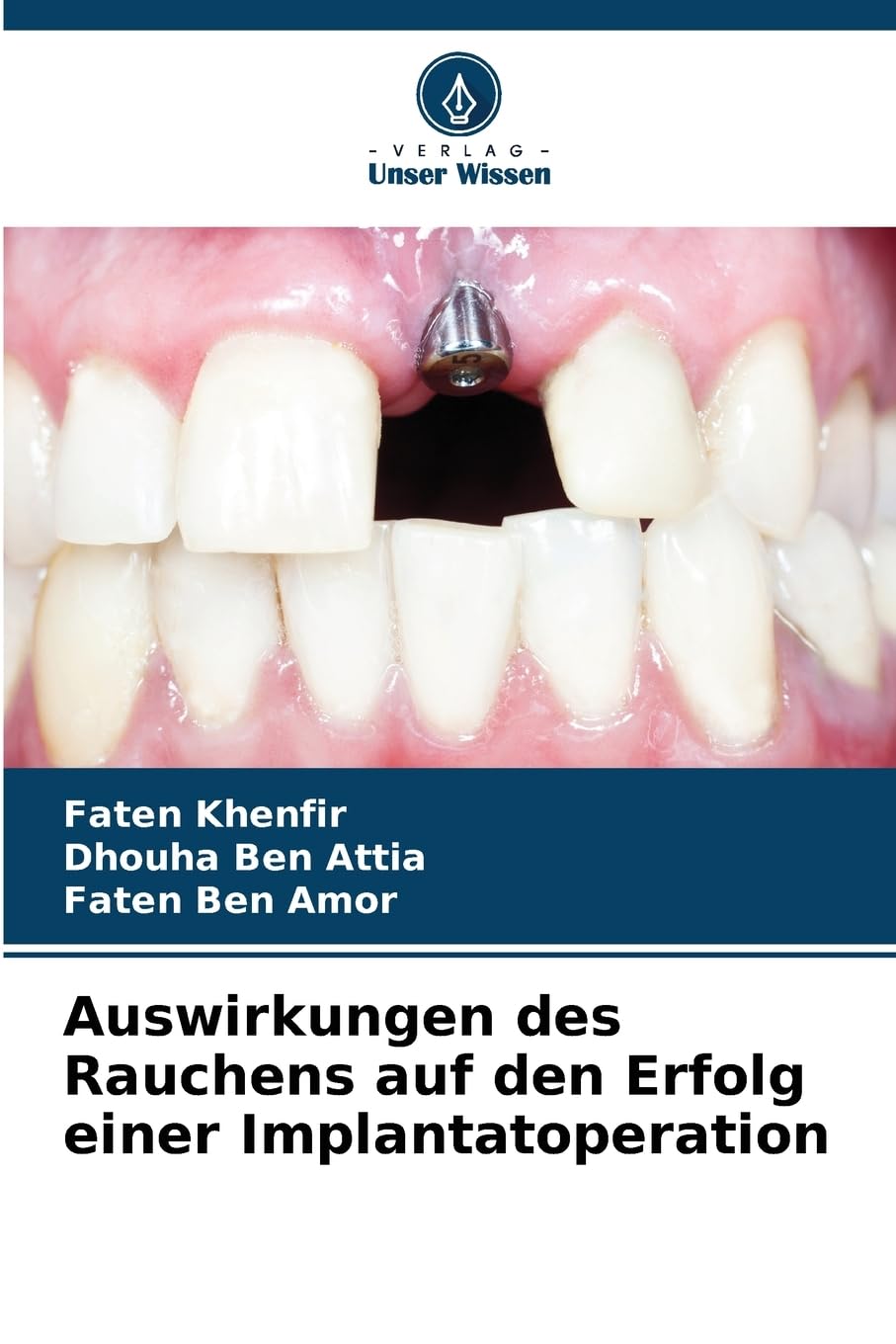 Auswirkungen des Rauchens auf den Erfolg einer Implantatoperation Medicine
